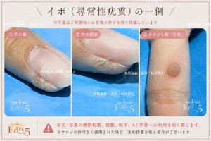 ３このイボの画像